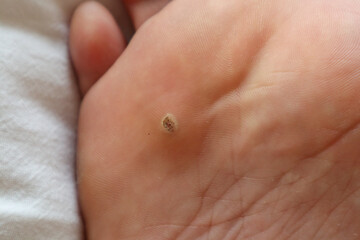 Close-up of an extensive wart on an adult foot