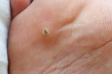Close-up of an extensive wart on an adult foot