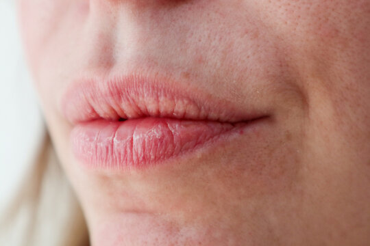 Close-up of woman's dry lips and skin with enlarged pores for cosmetic purposes