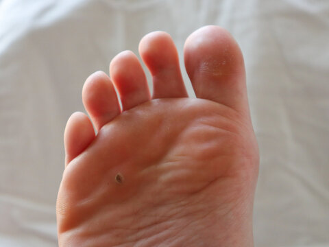 Close-up of an extensive wart on an adult foot