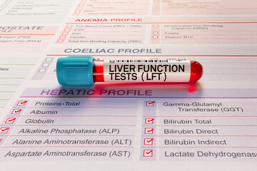 Blood sample tube for analysis Liver function tests LFTs checkup in laboratory. Blood tube test...