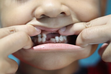 Kindergarten-aged children who put their hands and fingers on their mouths. he is opening his mouth to show damaged or broken teeth caused by accident inflicting pain on the body pitifully