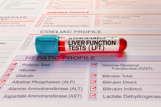 Blood sample tube for analysis Liver function tests LFTs checkup in laboratory. Blood tube test with requisition form for Liver function tests LFTs