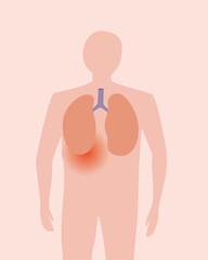 Pain in human organ of lungs and bronchi, flat vector stock illustration, abstract man, concept of disease