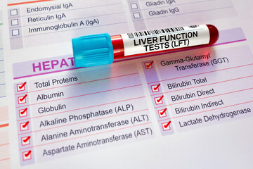 Blood sample tube for analysis of LFT Liver Function Tests in laboratory. Blood tube test with requisition form for Liver Function Tests LFT Hepatic Profile