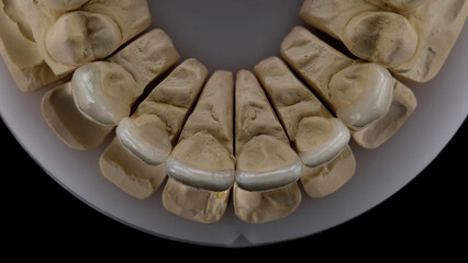 excellent angle on dental veneers top view on the model of the upper jaw, taken from above