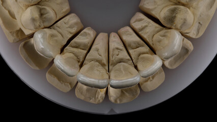 excellent angle on dental veneers top view on the model of the upper jaw, taken from above © Dental Pro Content