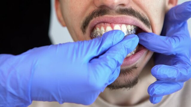 Orthodontist doctor in gloves putting silicone invisible transparent braces on man's teeth in stomatology clinic, mouth with mustache closeup view. Correcting teeth. Treatment and cure in dentistry.