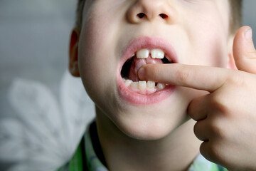 oral cavity of small patient, length of frenum of the tongue, boy, kid performs articulation...