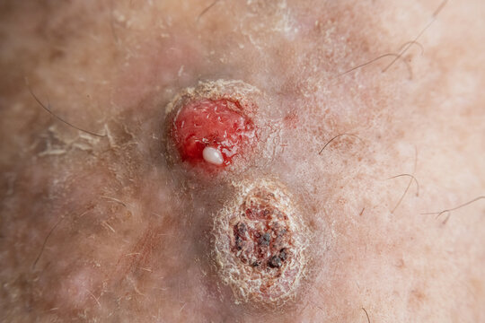 lacerated skin lesion with tumor