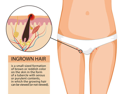 Ingrown hair. Informational training illustration. Female thighs in white underpants and a diagram of an ingrown hair with text. Vector illustration isolated on a white background for design and web.