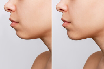 Сhin reduction. Cropped shot of woman's face with chin before and after mentoplasty isolated on a gray background. The result of cosmetic plastic surgery. Profile. Beauty concept - obrazy, fototapety, plakaty