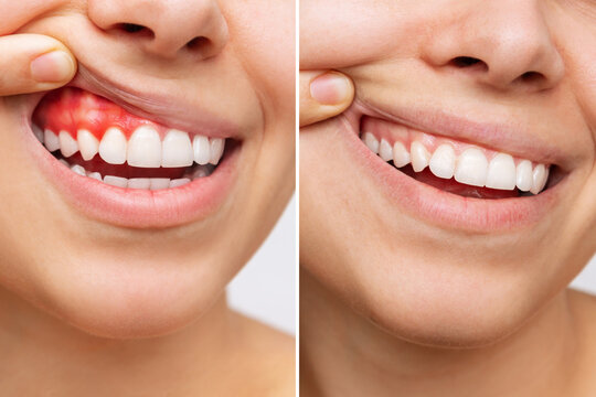 Two Shots Of A Young Woman With Red Bleeding Gums And Health Gums, Before And After Treatment On A White Background. Result Of Curing Of Gum Inflammation. Close Up. Dentistry, Dental Care