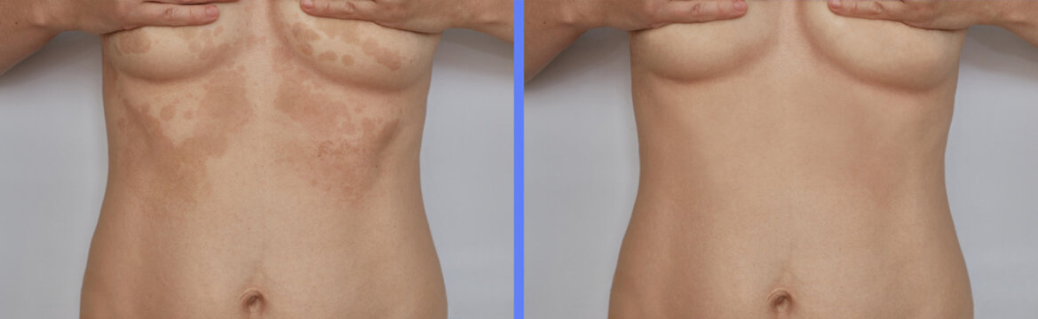 Shingles, pityriasis on the skin. Skin diseases and dermatological problems. Horizontal version of the photo before after.
