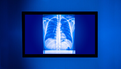 X-ray film of a man's chest seen from a monitor in a medical room.