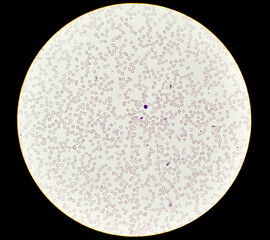 Hereditary hemolytic anemia. Hemoglobin E (HbE) disease, hypochromia with anisopoikilocytosis,...