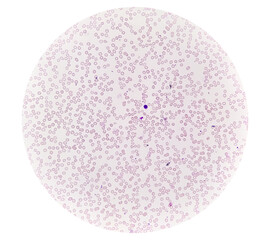 Hereditary hemolytic anemia. Hemoglobin E (HbE) disease, hypochromia with anisopoikilocytosis,...