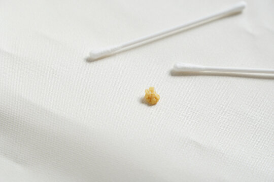 Flat lay of Cotton bud points to a Tonsils stone or Tonsillolith on white background with copy space. Medical concept. Selective focus.