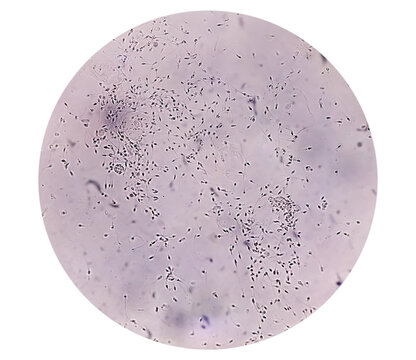 Polyzoospermia analyzed by microscope. Semen analysis normal sperm and morphology. Zoom image