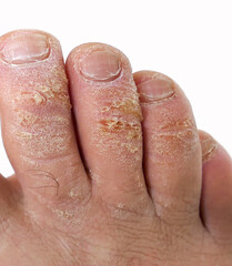 Fototapeta premium close-up of a man's toes with fungal disease, skin cracking and callus formation on his toes,