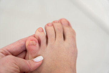 Woman touching her deformed double little toe