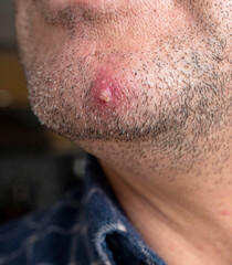 Naklejka premium inflamed acne on the facial skin of a person, single large acne on the face,