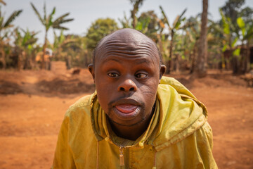 Portrait of an adult bald African man with Down syndrome, on a forest background
