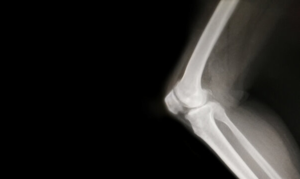 knee bone computer x-ray images
