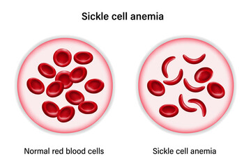 Sickle cell disease. The difference of Normal red blood cell and sickle cell.