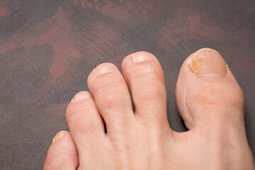 Toenails with fungus problems,Onychomycosis, also known as tinea unguium, is a fungal infection of the nail, dark background.