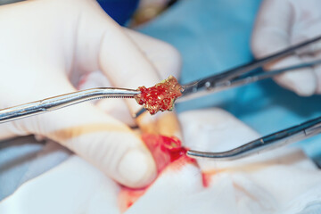 The surgical  process of removal of a foreign body from the intestine. © got