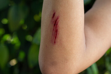 Wounds on the arm of a men due to an accident from fall.