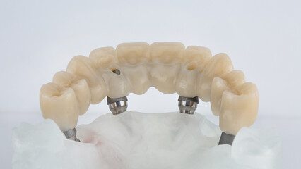 upper jaw prosthesis from the inside to the morphology of the teeth on the model. filmed on a white background © Dental Pro Content