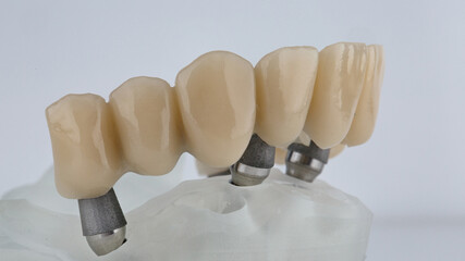  upper jaw prosthesis on model side view on white background © Dental Pro Content