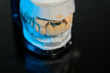 Dental implants and dentures in close-up Siemke on a black background