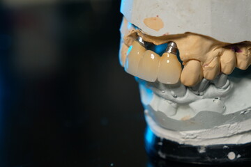 Dental implants and dentures in close-up Siemke on a black background
