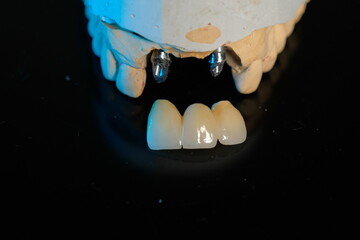 Dental implants and dentures in close-up Siemke on a black background