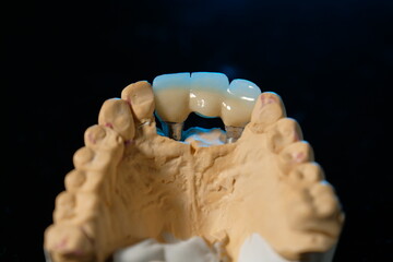 Dental implants and dentures in close-up Siemke on a black background