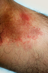 Itchy rash in the groin area. Tinea Cruris is a type of skin disease that occurs in the groin area.