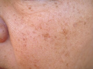 Fototapeta premium Problem skincare and health concept. wrinkles, dark spots, freckles, on face middle age woman. closeup photo, blurred.