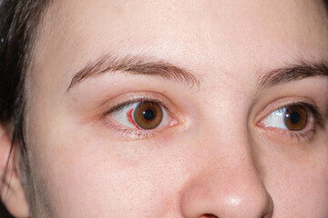 Macro human eyes, burst capillaries, bruising on white of the eye. Red spot after childbirth in a woman in labor, close-up.