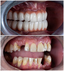 press ceramic crowns on implant bridges