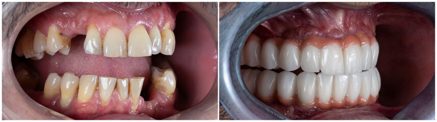 press ceramic crowns on implant bridges