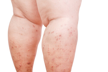 Itchy skin lesions from allergies, skin women