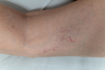 removal of blood vessels by laser vessel venous disease, varicose problem patient close vein, cutout risk enlarged, aesthetic telangiectases physical