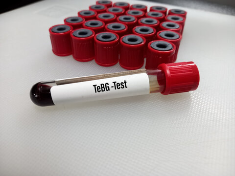 Blood sample for TeBG(Testosterone-estradiol binding globulin) test, sex hormone-binding globulin(SHBG), selective focus