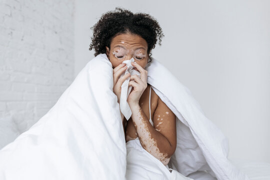 Sick woman with vitiligo blowing nose in tissue paper at home