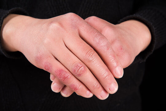 close up of female hand with chilblain on black background