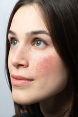 Face of girl with red cheeks from rosacea