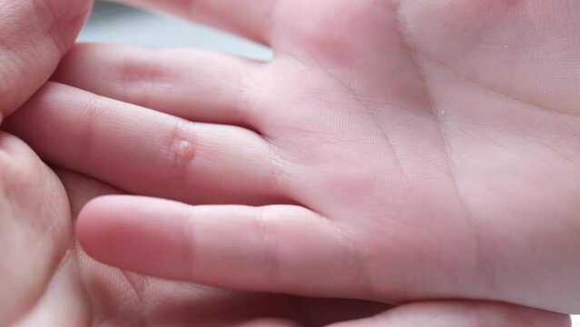 Doctor holds child hand with warts. Pediatric dermatology concept. Papillomavirus